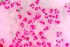 Neisseria_gonorrhoeae_in_urethral_discharge