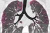 Low-Res_Cystic fibrosis patient lungs after treatment