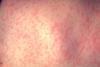 Morbillivirus_measles_infection