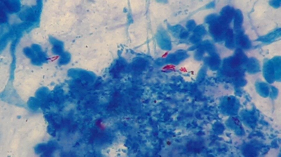 GeneXpert MTB/RIF technology can distinguish non-tuberculous ...
