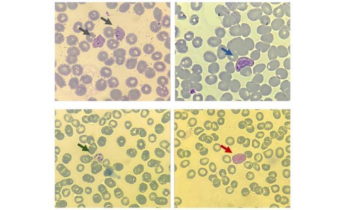 Scientists identify molecules associated with recurrence in blood ...