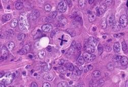 Pathologic_mitosis
