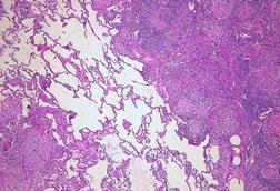 Pulmonary_tuberculosis_(6545189731)