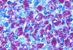 Lymph_node_-_Atypical_mycobacterial_infection_(MAI)_4
