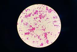 Nontuberculous_Mycobacteria_(NTM)_in_Ziehl-Neelsen_Staining_from_Positive_MGIT_Culture (1)