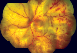 PMID20029144_05_progressive_outer_retinal_necrosis_-_cracked_mud