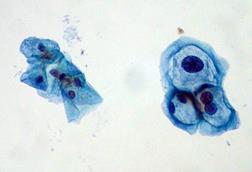 ThinPrep_Pap_smear_HPV