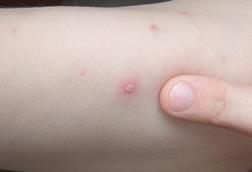 Chickenpox_blister_2006.01.06
