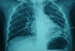 Pneumonia_and_pleural_effusions_on_the_lower_left_lung_(2.5_y.o._child)