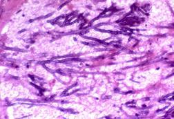 Aspergillosis,_angioinvasive,_intravascular_(5390967599)