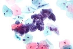 Herpes_simplex_virus_pap_test_2