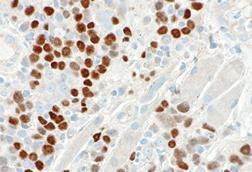 Consistent_with_HPV-associated_SCC_-_p40_--_high_mag
