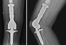Knee_arthroplasty_due_to_a_chondrosarcoma_2