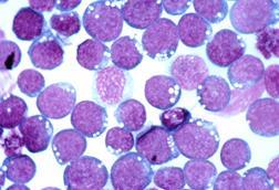 Epstein-barr_virus_(ebv)