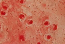 Gram_negative_coccobacilli_of_Acinetobacter_in_bronchoalveolar_lavage_(BAL)_Gram_staining