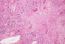 Histopathology_of_massive_hepatic_necrosis_in_hepatitis_B (1)