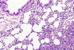 pulmonary_fibrosis-m-1140x760