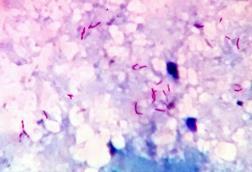 Acid_fast_bacilli_in_sputum_smear