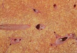 Cirrhosis_liver