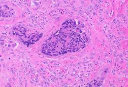Histopathology_of_colorectal_adenocarcinoma_with_lymphatic_invasion