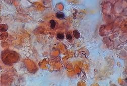 Pneumococcus_in_Gram-Stained_BAL_Sample