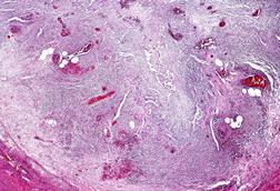 Acute_appendicitis,_low_mag.2