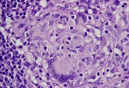 Granulomas_in_an_intestinal_lymph_node_in_Crohn's_disease,_HE_5