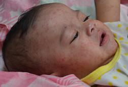 Measles_child_Philippines