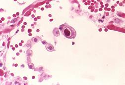 Cytomegalovirus_01