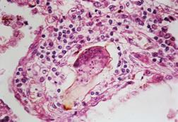 Schistosomiasis_(13383125494)