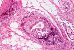 Tumor_invasion_into_vein_in_a_case_of_colorectal_cancer,_Elastica_stain_2