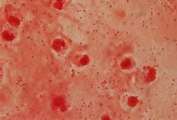 Gram_negative_coccobacilli_of_Acinetobacter_in_bronchoalveolar_lavage_(BAL)_Gram_staining (1)