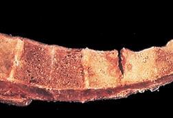 Tuberculosis_of_spinal_column_(6539943165)