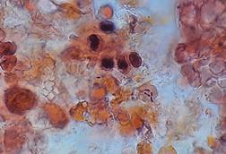 Pneumococcus_in_Gram-Stained_BAL_Sample (1)