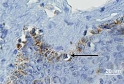 Human_papilloma_virus_(HPV)_1618_E6_staining_in_normal_and_ductal_carcinoma_in_situ_(DCIS)_breast_cancer_specimens