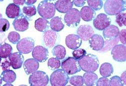 Epistein-Barr_Virus_(EBV)