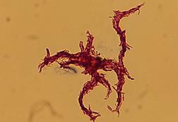 Serpentine_cords_of_red-stained,_acid-fast_structure_in_a_Ziehl-Neelsen_stained_smear_of_Mycobacterium_tuberculosis_complex_(MTBC)_from_liquid_culture