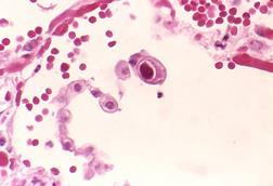 Cytomegalovirus_01