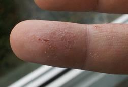 Eczema_versus_Fingerprints_2009