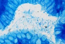 Helicobacter_pylori,_Gastric_Biopsy,_Giemsa_Stain_(5517582111)