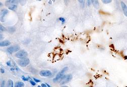 Immunohistochemical_detection_of_Helicobacter_pylori_histopathology