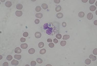 Pseudomonas_aeruginosa_smear_MGG_2010-02-10