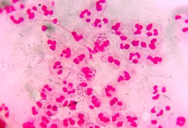 Neisseria_gonorrhoeae_in_urethral_discharge