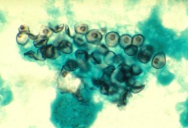 Pneumocystis_carinii_in_smear_from_BAL_01ee046_lores