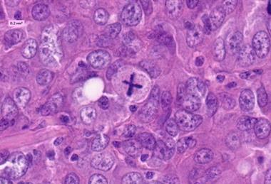 Pathologic_mitosis