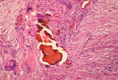Fecal_matter_foreign_body