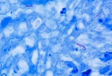 Mycobacterium_tuberculosis_Ziehl-Neelsen_stain_640