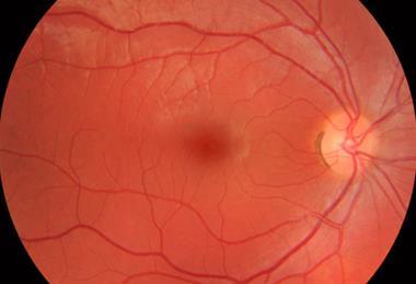 Fundus_photograph_of_normal_right_eye