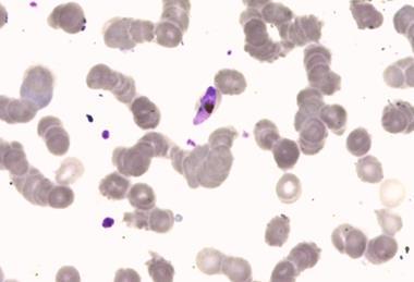 Plasmodium_falciparum_malaria,_1000x