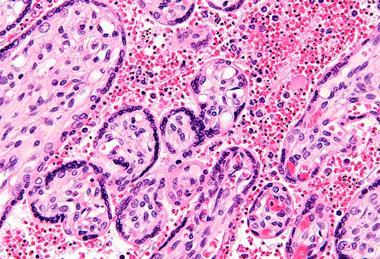 Maternal_malaria_placenta_-_very_high_mag